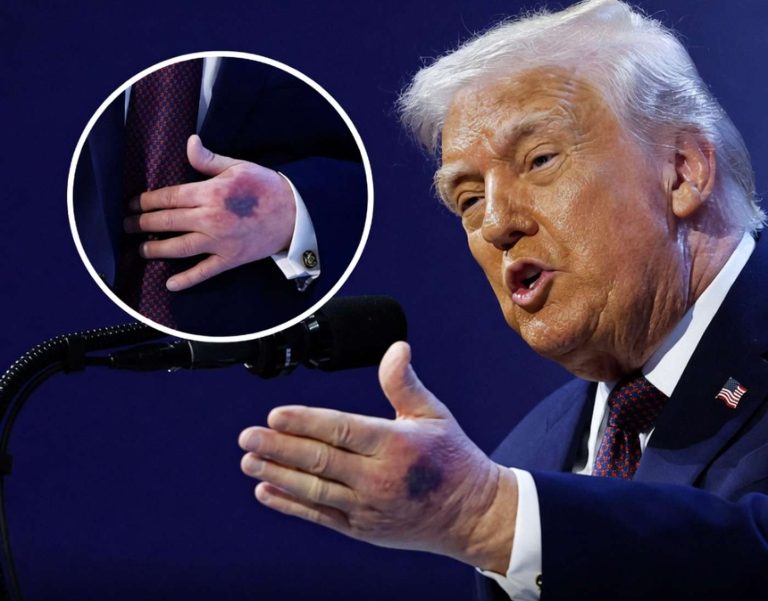 donald Trump gestures while speaking, revealing a bruise on his hand